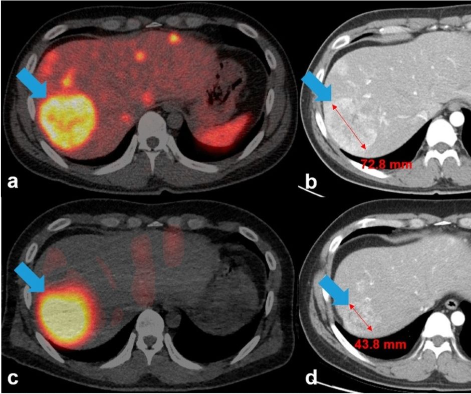 Lu-177 DOTA Therapy for Neuroendocrine Tumors