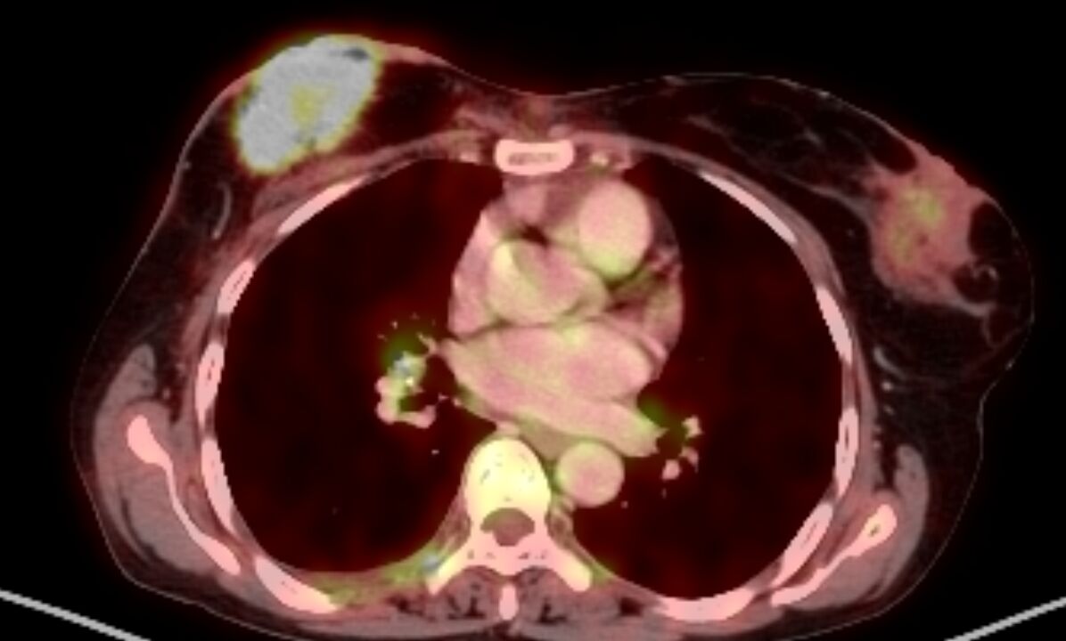 FDG PET-CT in Initial Staging of Breast Cancer – Case Report | NeuMoD Hubli Dr  Rashmi Angadi