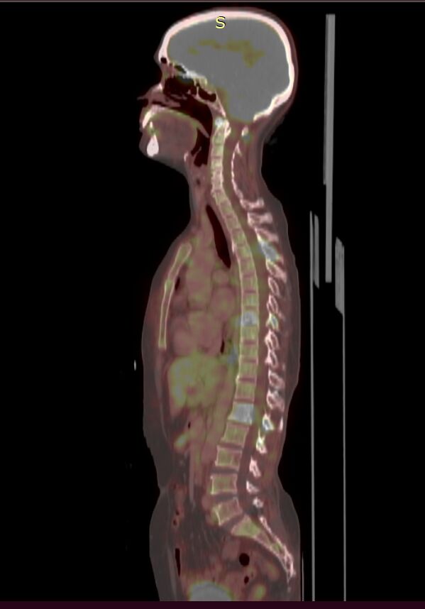 fdg-pet-ct-in-initial-staging-of-breast-cancer--case-report--neumod-hubli-dr--rashmi-angadi-image