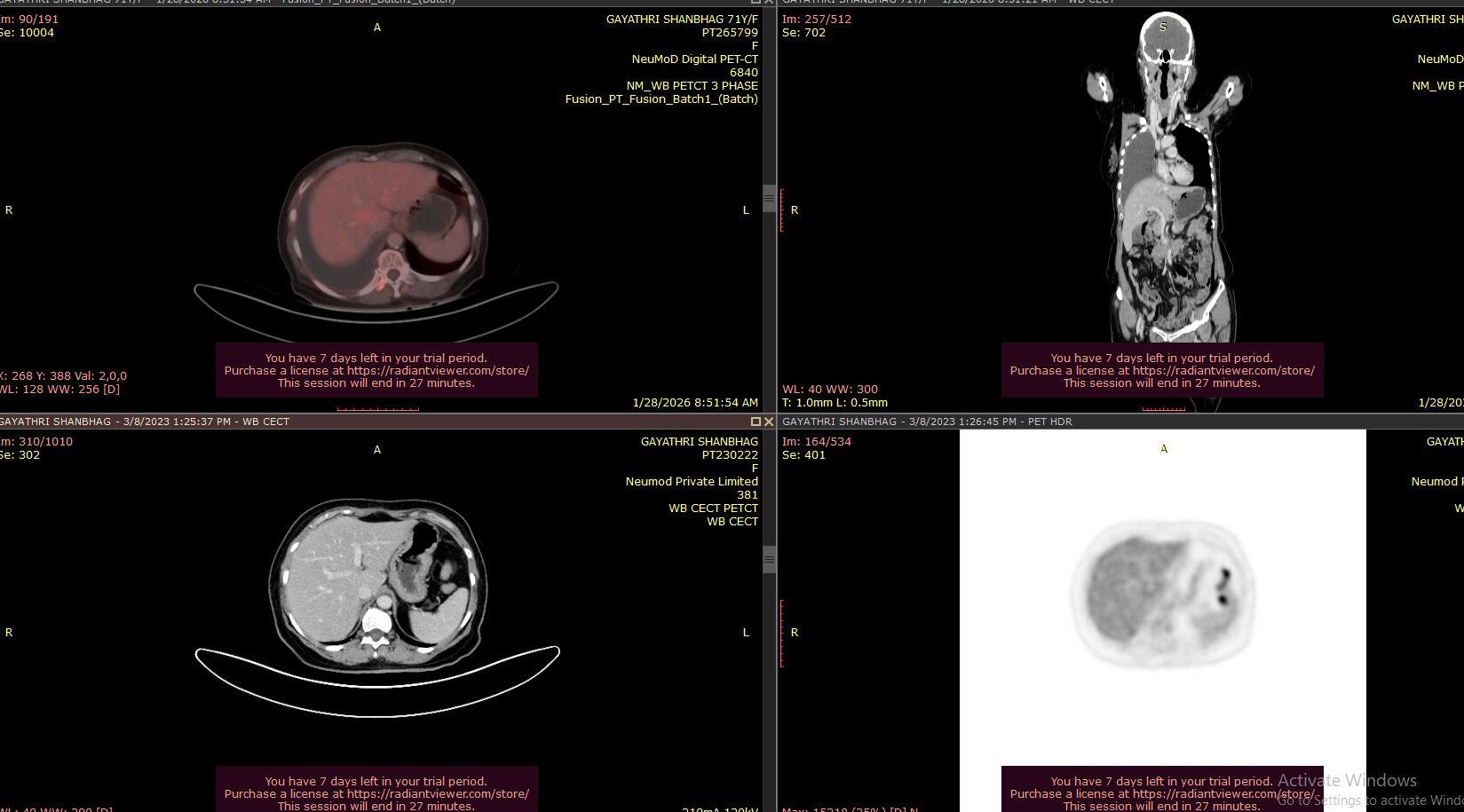 68Ga-FAPI PET-CT in Detecting Disease Progression in Recurrent Ovarian Cancer: A Case Report